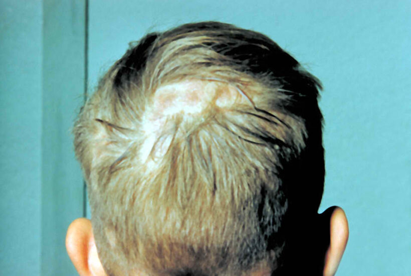 treatments involving scalp micropigmentation in miami