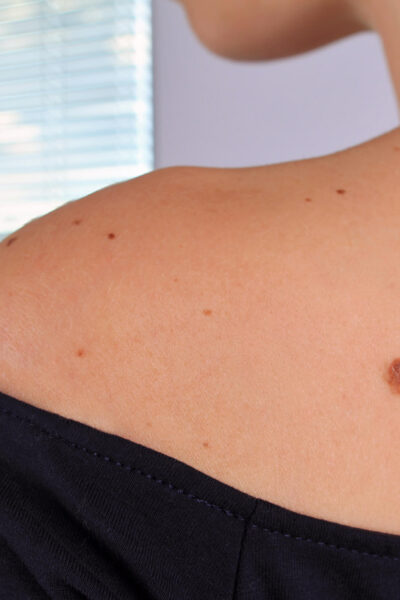 How to Examine Your Moles