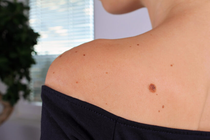 how to examine your moles
