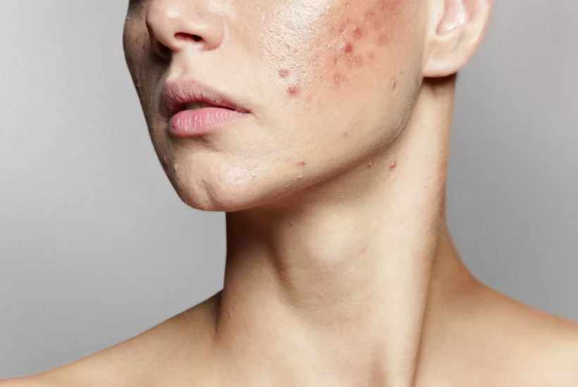 Essential Things You Didn’t Know About Acne